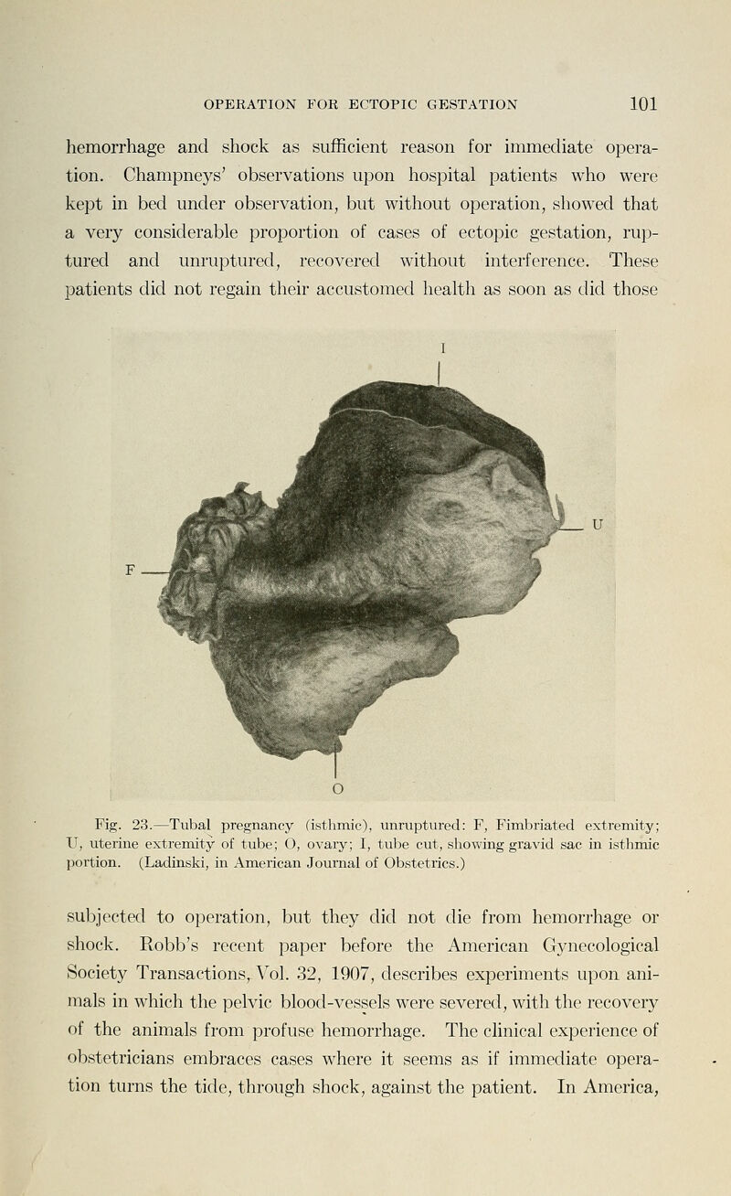 hemorrhage and shock as sufficient reason for immediate opera- tion. Champneys' observations upon hospital patients who were kept in bed under observation, but without operation, showed that a very considerable proportion of cases of ectopic gestation, rup- tured and unruptured, recovered without interference. These patients did not regain their accustomed health as soon as did those u Fig. 23.—Tubal pregnancy (isthmic), unruptured: F, Fimbriated extremity; U, uterine extremity of tube; O, ovary; I, tube cut, showing gravid sac in isthmic portion. (Ladinski, in American Journal of Obstetrics.) subjected to operation, but they did not die from hemorrhage or shock. Robb's recent paper before the American Gynecological Society Transactions, Vol. 32, 1907, describes experiments upon ani- mals in which the pelvic blood-vessels were severed, with the recovery of the animals from profuse hemorrhage. The clinical experience of obstetricians embraces cases where it seems as if immediate opera- tion turns the tide, through shock, against the patient. In America,