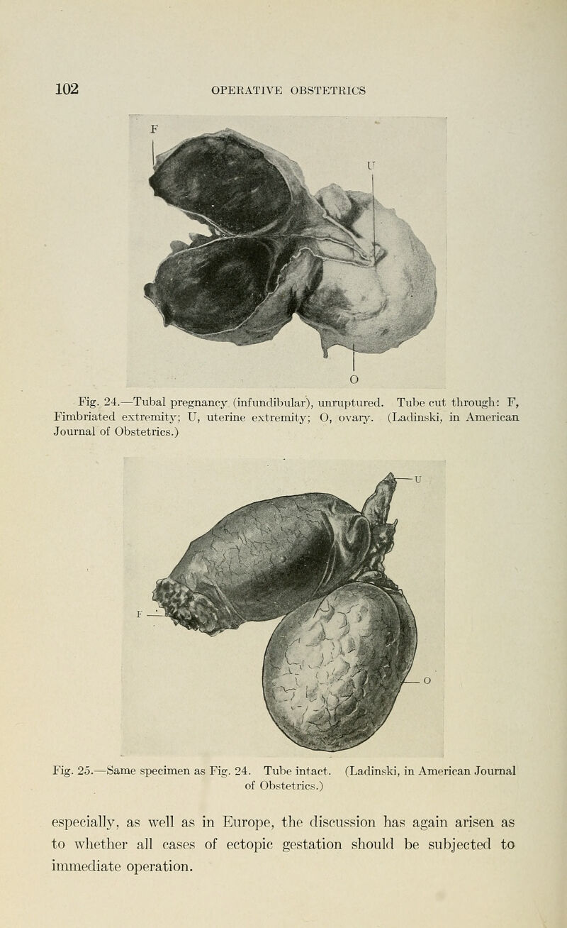 Fig. 24.—Tubal pregnancy (infundibular), unruptured. Tube cut through: F, Fimbriated extremity; U, uterine extremity; O, ovaiy. (Ladinski, in American Journal of Obstetrics.) Fig. 25.—Same specimen as Fig. 24. Tube intact. (Ladinski, in American Journal of Obstetrics.) especially, as well as in Europe, the discussion has again arisen as to whether all cases of ectopic gestation should be subjected to immediate operation.