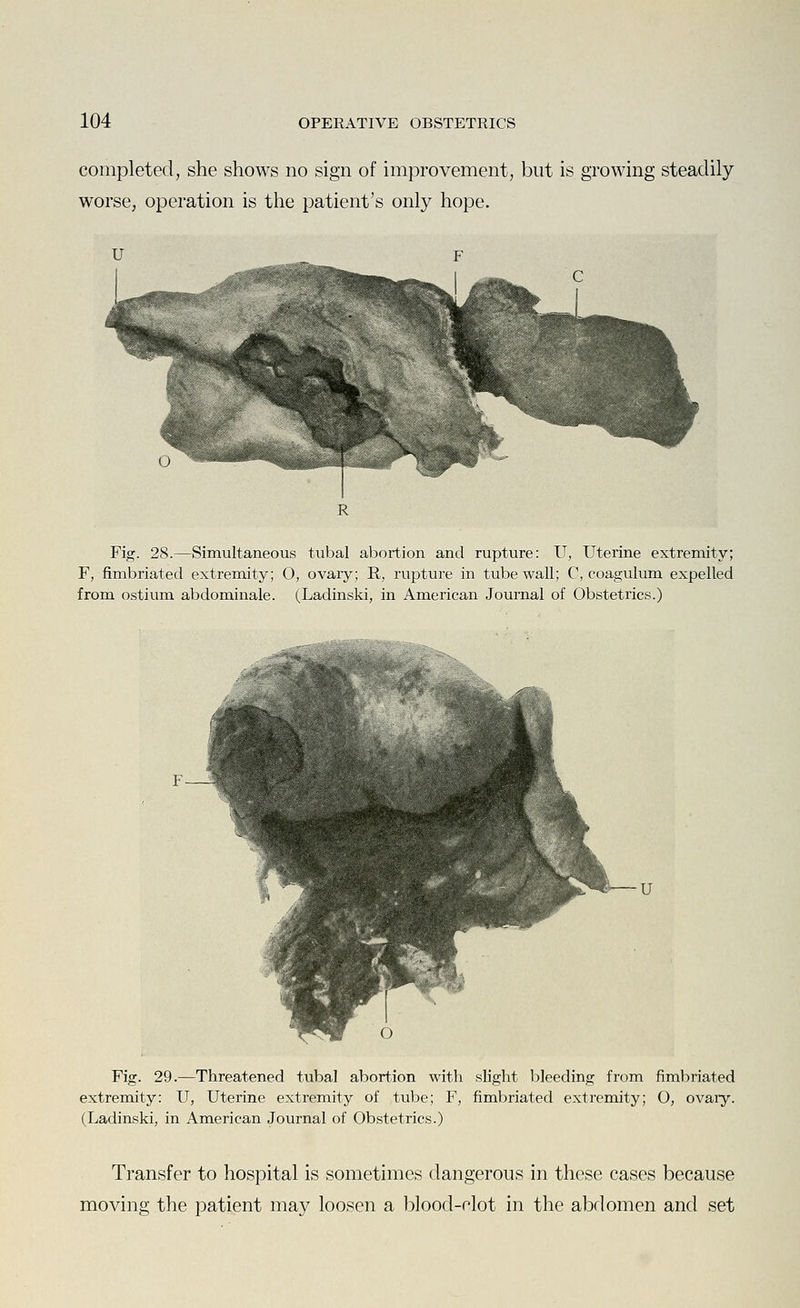 completed, she shows no sign of improvement, but is growing steadily worse, operation is the patient's only hope. Fig. 28.—Simultaneous tubal abortion and rupture: U, Uterine extremity; F, fimbriated extremity; O, ovary; R, rupture in tube wall; C, coagulum expelled from ostium abdominale. (Ladinski, in American Journal of Obstetrics.) Fig. 29.—Threatened tubal abortion with slight bleeding from fimbriated extremity: U, Uterine extremity of tube; F, fimbriated extremity; O, ovaiy. (Ladinski, in American Journal of Obstetrics.) Transfer to hospital is sometimes dangerous in these cases because moving the patient may loosen a blood-clot in the abdomen and set