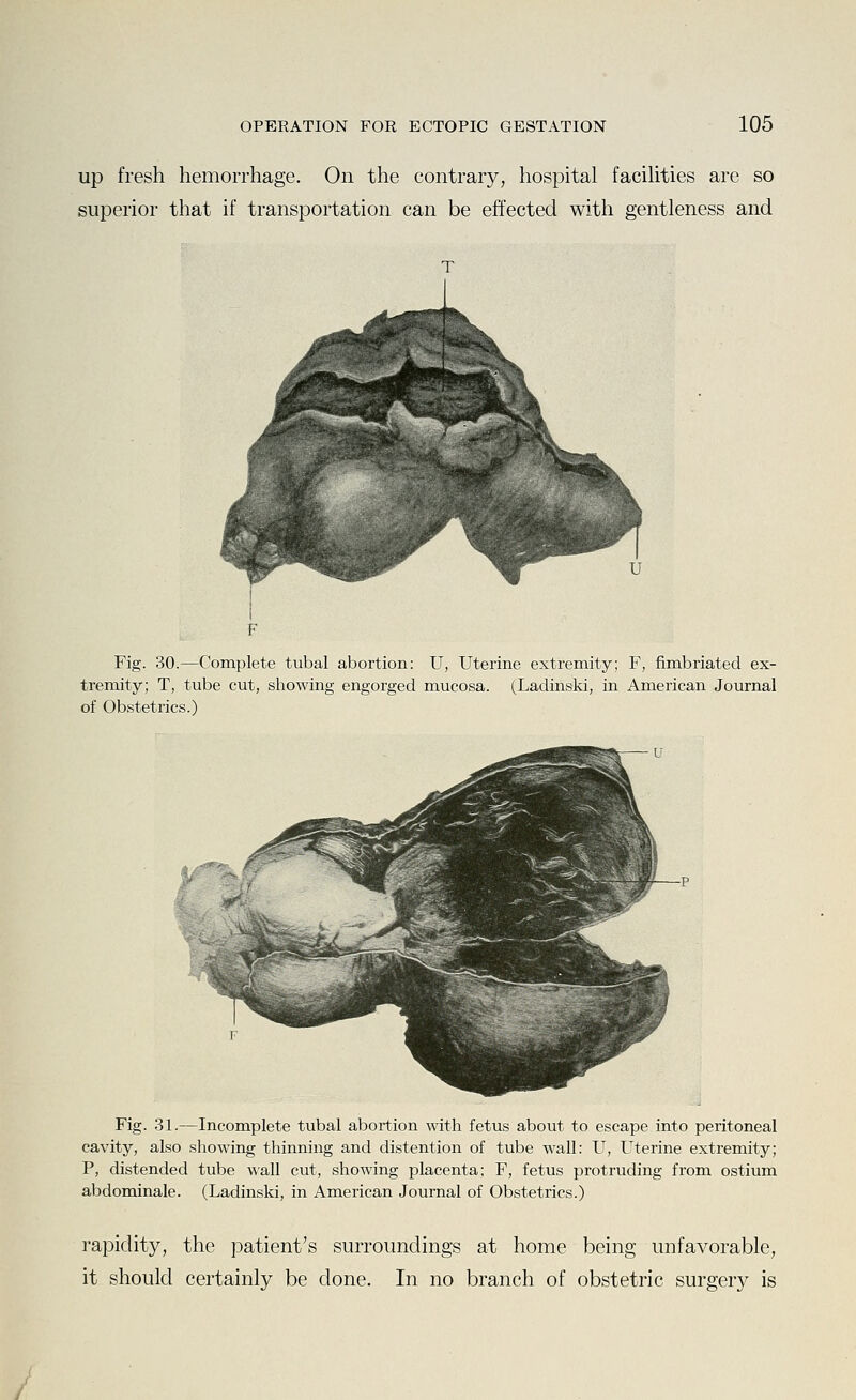 up fresh hemorrhage. On the contrary, hospital facihties are so superior that if transportation can be effected with gentleness and Fig. 30.—Complete tubal abortion: U, Uterine extremity; F, fimbriated ex- tremity; T, tube cut, showing engorged mucosa. (Ladinski, in American Journal of Obstetrics.) Fig. 31.—Incomplete tubal abortion with fetus about to escape into peritoneal cavity, also showing thinning and distention of tube wall: U, Uterine extremity; P, distended tube wall cut, showing placenta; F, fetus protruding from ostium abdominale. (Ladinski, in American Journal of Obstetrics.) rapidity, the patient's surroundings at home being unfavorable, it should certainly be done. In no branch of obstetric surgery is /