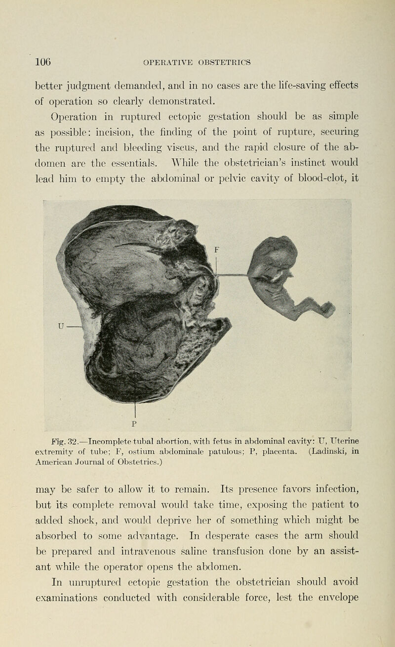 better judgment demanded, and in no cases are the life-saving effects of operation so clearly demonstrated. Operation in ruptured ectopic gestation should be as simple as possible: incision, the finding of the point of rupture, securing the ruptured and bleeding viscus, and the rapid closure of the ab- domen are the essentials. While the obstetrician's instinct would lead him to empty the abdominal or pelvic cavity of blood-clot, it Fig. 32.—Incomplete tubal abortion, with fetus in abdominal cavity: U, Uterine extremity of tube; F, ostium abdominale patulous; P, placenta. (Ladinski, in American Journal of Obstetrics.) may be safer to allow it to remain. Its presence favors infection, but its complete removal would take time, exposing the patient to added shock, and would deprive her of something which might be absorbed to some advantage. In desperate cases the arm should be prepared and intravenous saline transfusion done by an assist- ant while the operator opens the abdomen. In unruptured ectopic gestation the obstetrician should avoid examinations conducted with considerable force, lest the envelope
