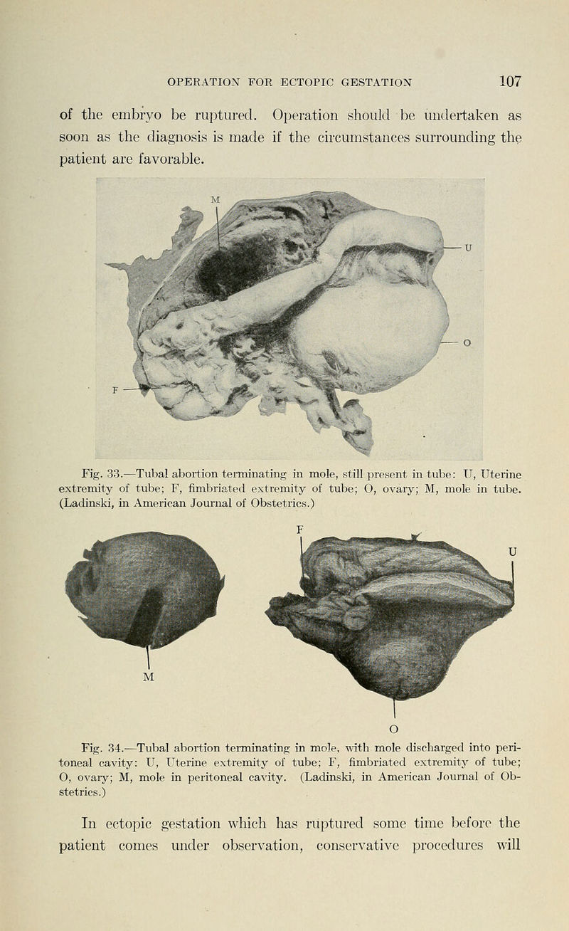 of the embryo be ruptured. Operation should be undertaken as soon as the diagnosis is made if the circumstances surrounding the patient are favorable. r— o Fig. 33.—Tubal abortion terminating in mole, still present in tube: U, Uterine extremity of tube; F, fimbriated extremity of tube; O, ovary; M, mole in tube. (Ladinski, in American Journal of Obstetrics.) Fig. 34.—Tubal abortion terminating in mole, with mole discharged into peri- toneal cavity: U, Uterine extremity of tube; F, fimbriated extremity of tube; O, ovary; M, mole in peritoneal cavity. (Ladinski, in American Journal of Ob- stetrics.) In ectopic gestation which has ruptured some time before the patient comes under observation, conservative procedures will
