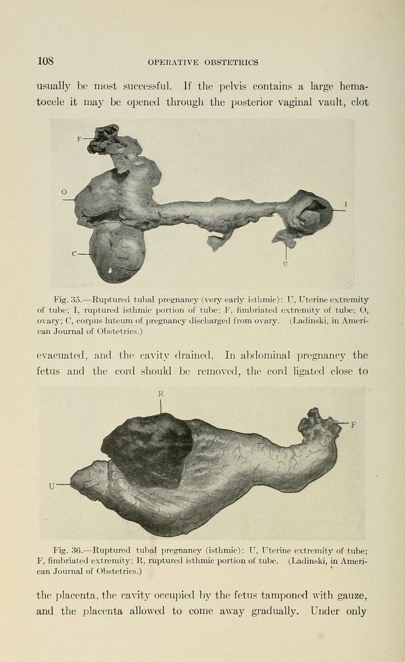 usually be most successful. If the pelvis contains a large hema- tocele it may be opened through the posterior vaginal vault, clot Fig. 35.—Ruptured tubal pregnancy (very early isthmic): U, Uterine extremity of tube; I, ruptured isthmic portion of tube; F, fimbriated extremity of tube; O, ovary; C, corpus luteum of jiregnancy discharged from ovary. (Ladinski, in Ameri- can Journal of Obstetrics.) evacuated, and the cavity drained. In abdominal pregnancy the fetus and the cord should be removed, the cord ligated close to Fig. 36.—Ruptured tubal pregnancy (isthmic): U, Uterine extremity of tube; F, fimbriated extremity; R, ruptured isthmic portion of tube. (Ladinski, in Ameri- can Journal of Obstetrics.) the placenta, the cavity occupied by the fetus tamponed with gauze, and the placenta allowed to come away gradually. Under only