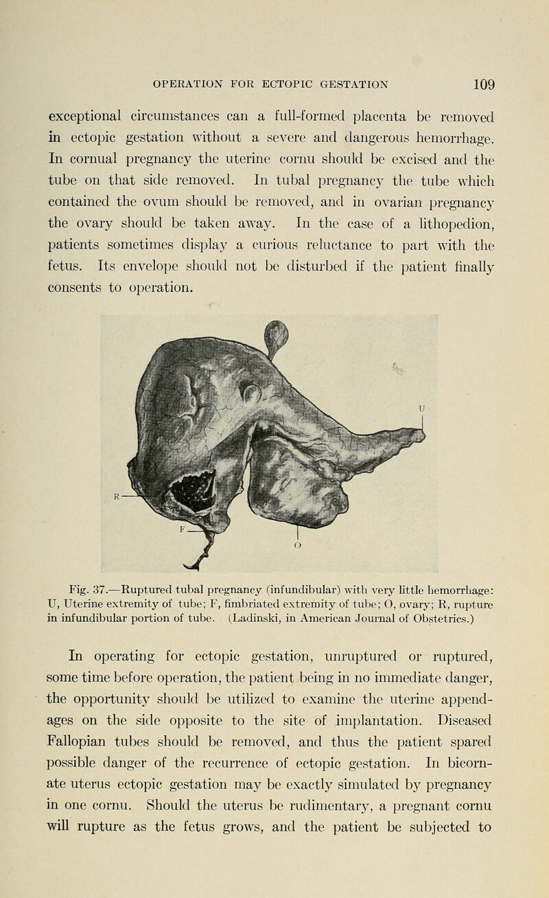 exceptional circumstances can a full-formed placenta be removed in ectopic gestation without a severe and dangerous hemorrhage. In cornual pregnancy the uterine cornu should be excised and the tube on that side removed. In tubal pregnancy the tube which contained the ovum should be removed, and in ovarian pregnancy the ovary should be taken away. In the case of a lithopedion, patients sometimes display a curious reluctance to part with the fetus. Its envelope should not be disturbed if the patient finally consents to operation. Fig. 37.—Ruptured tubal pregnancy (infundibular) with very little hemorrhage: U, Uterine extremity of tube; F, fimbriated extremity of tube; O, ovary; R, rupture in infundibular portion of tube. (Ladinski, in American Journal of Obstetrics.) In operating for ectopic gestation, unruptured or ruptured, some time before operation, the patient being in no immediate danger, the opportunity should be utilized to examine the uterine append- ages on the side opposite to the site of implantation. Diseased Fallopian tubes should be removed, and thus the patient spared possible danger of the recurrence of ectopic gestation. In bicorn- ate uterus ectopic gestation may be exactly simulated by pregnancy in one cornu. Should the uterus be rudimentary, a pregnant cornu will rupture as the fetus grows, and the patient be subjected to