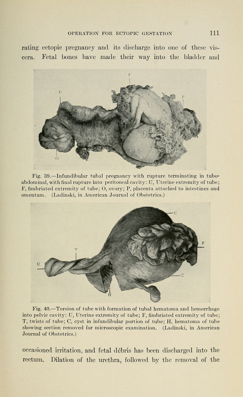 rating ectopic pregnancy and its discharge into one of these vis- cera. Fetal bones have made their way into the bladder and Fig. 39.—Infundibular tubal pregnancy with rupture terminating in tubo- abdominal, with final rupture into peritoneal cavity: U, Uterine extremity of tube; F, fimbriated extremity of tube; O, ovary; P, placenta attached to intestines and omentum. (Ladinski, in American Journal of Obstetrics.) Fig. 40.—Torsion of tube with formation of tubal hematoma and hemorrhage into pelvic cavity: U, Uterine extremity of tube; F, fimbriated extremity of tube; T, twists of tube; C, cyst in infundibular portion of tube; H, hematoma of tube showing section removed for microscopic examination. (Ladinski, in American Journal of Obstetrics.) occasioned irritation, and fetal debris has been discharged into the rectum. Dilation of the urethra, followed by the removal of the