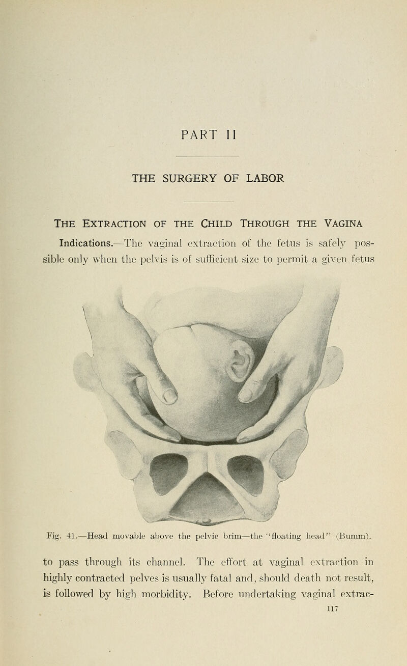 PART II THE SURGERY OF LABOR The Extraction of the Child Through the Vagina Indications.—The vaginal extraction of the fetus is safely pos- sible only when the pelvis is of sufficient size to permit a given fetus \ Fig. 41.—Head movable above the pelvic brim—tlie floating head (Bumm). to pass through its channel. The effort at vaginal extraction in highly contracted pelves is usually fatal and, should death not result, is followed by high morbidity. Before undertaking vaginal extrac-