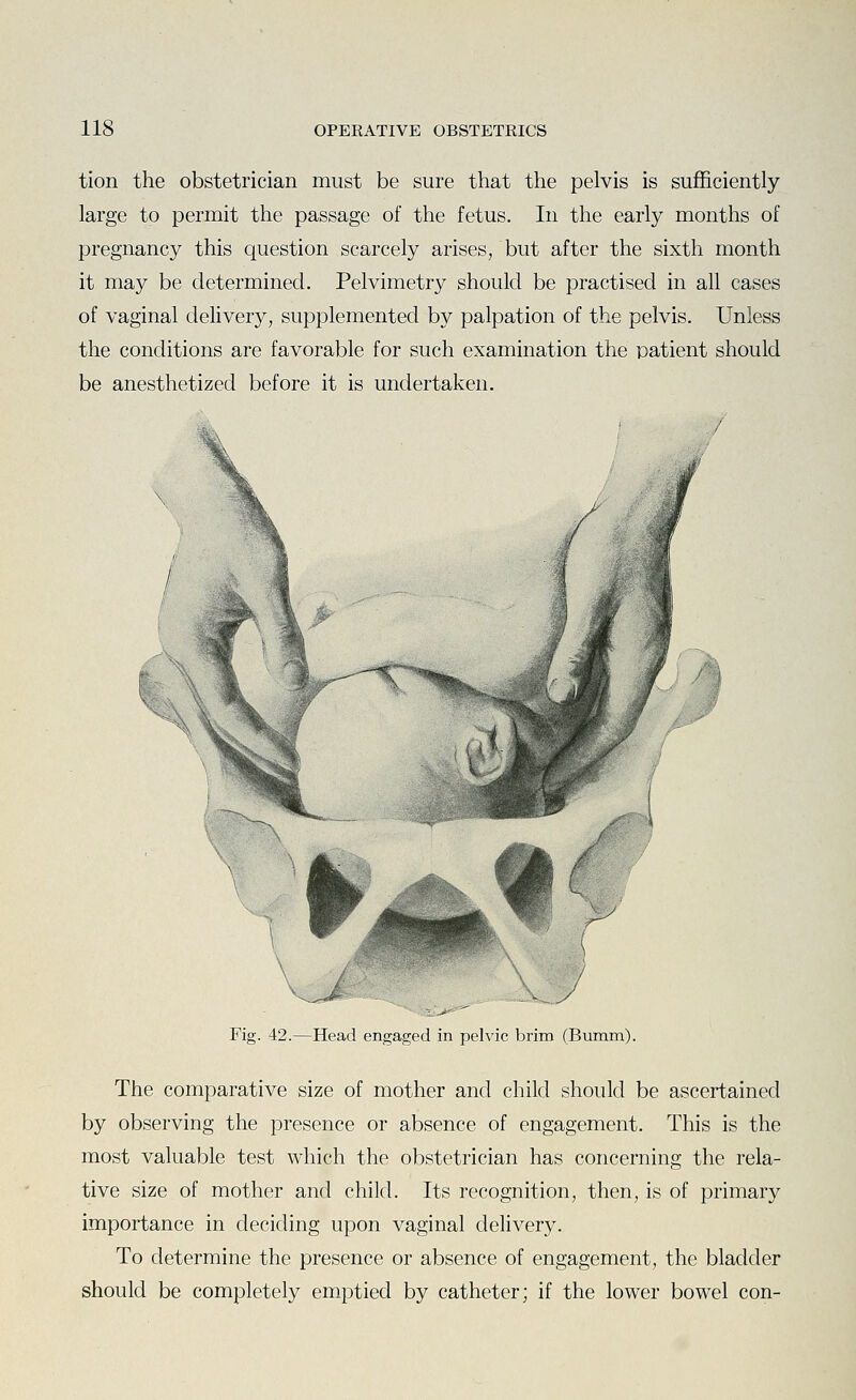 tion the obstetrician must be sure that the pelvis is sufficiently large to permit the passage of the fetus. In the early months of pregnancy this question scarcely arises, but after the sixth month it may be determined. Pelvimetry should be practised in all cases of vaginal delivery, supplemented by palpation of the pelvis. Unless the conditions are favorable for such examination the patient should be anesthetized before it is undertaken. ¥ w ^ .y Fig. 42.—Head engaged in pelvic brim (Bumm). The comparative size of mother and child should be ascertained by observing the presence or absence of engagement. This is the most valuable test which the obstetrician has concerning the rela- tive size of mother and child. Its recognition, then, is of primary importance in deciding upon vaginal delivery. To determine the presence or absence of engagement, the bladder should be completely emptied by catheter; if the lower bowel con-