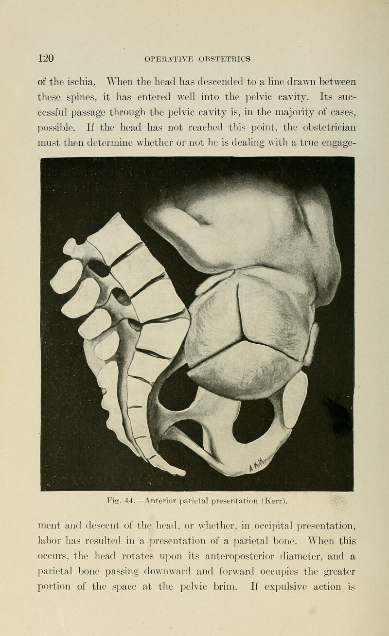 of the ischia. When the head has descended to a hne drawn between these spines, it has entered well into the pelvic cavity. Its suc- cessful passage through the pelvic cavity is, in the majority of cases, possible. If the head has not reached this point, the obstetrician must then determine whether or not he is dealing with a true engage- Fig. 44.—Anterior parietal presentation (Kerr). ment and descent of the head, or whether, in occipital presentation, labor has resulted in a presentation of a parietal bone. When this occurs, the head rotates upon its anteroposterior diameter, and a parietal bone passing downward and forward occupies the greater portion of the space at the pelvic brim. If expulsive action is