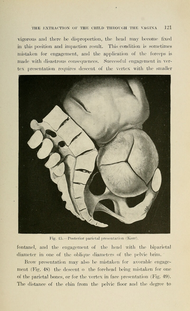 vigorous and there be disproportion, the head may become fixed in this position and impaction result. This condition is sometimes mistaken for engagement, and tlie appHcation of the forceps is made with disastrous consequences. Successful engagement in ver- tex presentation requires descent of the vertex with the smaller Fig. 45.—Posterior parietal presentation (Kerr). fontanel, and the engagement of the head with the biparietal diameter in one of the oblique diameters of the pelvic brim. ' Brow presentation may also be mistaken for avorable engage- ment (Fig, 48) the descent o the forehead being mistaken for one of the parietal bones, or for the vertex in face presentation (Fig. 49). The distance of the chin from the pelvic floor and the degree to