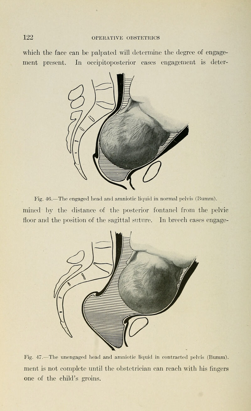 which the face can be palpated will determine the degree of engage- ment present. In occipitoposterior cases engagement is deter- Fig. 46.—The engaged head and amniotic liquid in normal pelvis (Bumm). mined by the distance of the posterior fontanel from the pelvic floor and the position of the sagittal suture. In breech cases engage- Fig. 47.—The unengaged head and amniotic liquid in contracted pelvis (Bumm). ment is not complete until the obstetrician can reach with his fingers one of the child's groins.