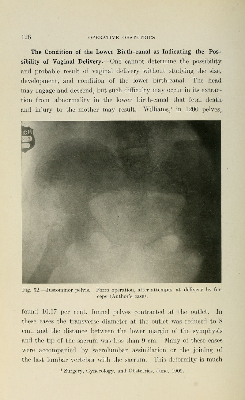 The Condition of the Lower Birth-canal as Indicating the Pos- sibility of Vaginal Delivery.—One cannot determine the possibility and probable result of vaginal delivery without studying the size, development, and condition of the lower birth-canal. The head may engage and descend, but such difficulty may occur in its extrac- tion from abnormality in the lower birth-canal that fetal death and injury to the mother may result. Williams/ in 1200 pelves, Fig. 52.—Justominor pelvis. Porro operation, after attempts at delivery by for- ceps (Author's case). found 10.17 per cent, funnel pelves contracted at the outlet. In these cases the transverse diameter at the outlet was reduced to 8 cm., and the distance between the lower margin of the symphysis and the tip of the sacrum was less than 9 cm. Many of these cases were accompanied by sacrolumbar assimilation or the joining of the last lumbar vertebra with the sacrum. This deformity is much ^ Surgery, Gynecology, and Obstetrics, June, 1909.