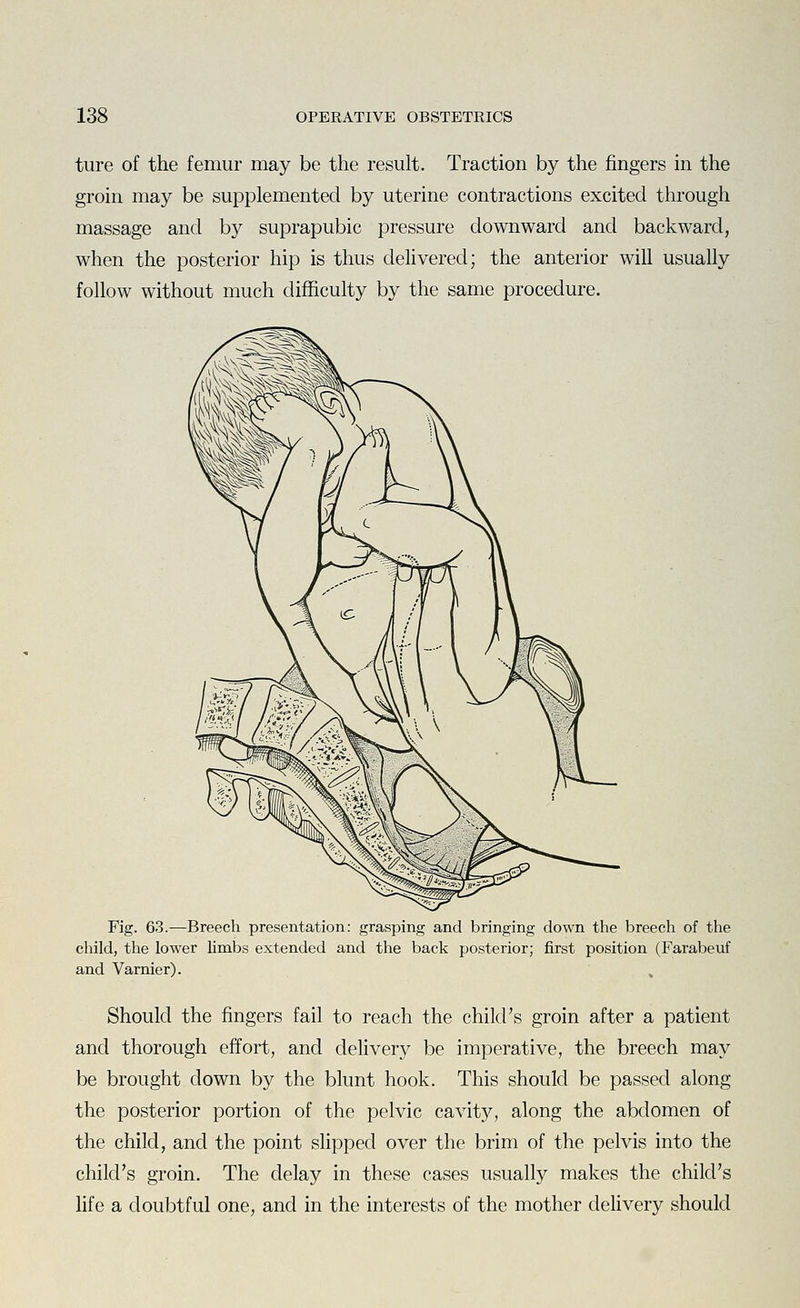 ture of the femur may be the result. Traction by the fingers in the groin may be supplemented by uterine contractions excited through massage and by suprapubic pressure downward and backward, when the posterior hip is thus dehvered; the anterior will usually follow without much difficulty by the same procedure. Fig. 63.—Breech presentation: grasping and bringing down the breech of the child, the lower limbs extended and the back posterior; first position (Farabeuf and Varnier). Should the fingers fail to reach the child's groin after a patient and thorough effort, and delivery be imperative, the breech may be brought down by the blunt hook. This should be passed along the posterior portion of the pelvic cavity, along the abdomen of the child, and the point slipped over the brim of the pelvis into the child's groin. The delay in these cases usually makes the child's life a doubtful one, and in the interests of the mother dehvery should