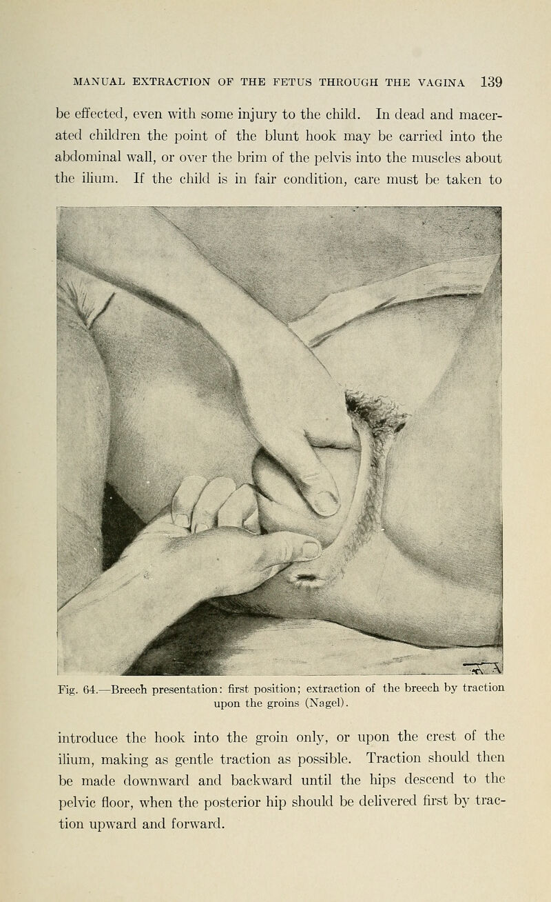 be effected, even with some injury to the child. In dead and macer- ated children the point of the blunt hook may be carried into the abdominal wall, or over the brim of the pelvis into the muscles about the iMum. If the child is in fair condition, care must be taken to / -5C3 Fig. 64.—Breech presentation: first position; extraction of the breech by traction upon the groins (Nagel). introduce the hook into the groin only, or upon the crest of the ilium, making as gentle traction as possible. Traction should then be made downward and backward until the hips descend to the pelvic floor, when the posterior hip should be delivered first by trac- tion upward and forward.