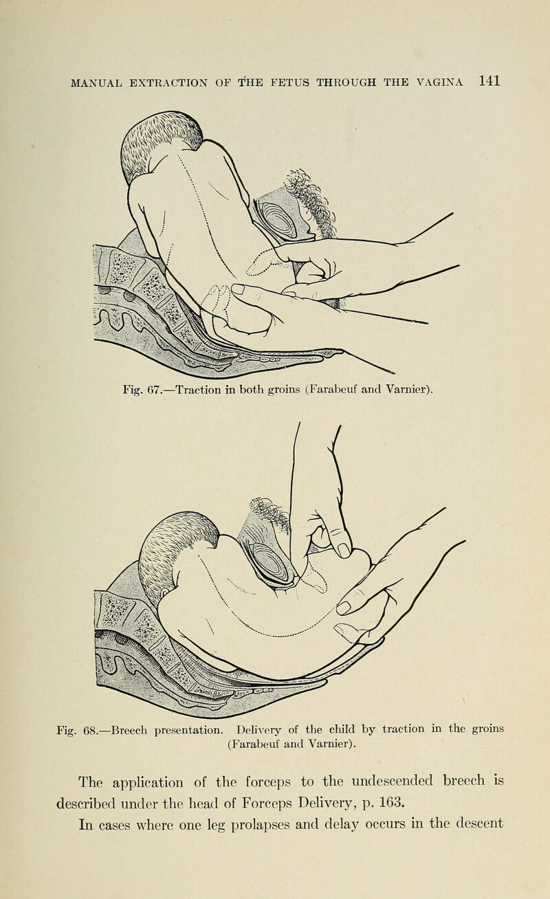 Fig. 67.—Traction in both groins (Farabeuf and Varnier). Fig. 68.—Breech presentation. DehA^ery of the child by traction in the groins (Farabeuf and Varnier). The application of the forceps to the undescended breech is described under the head of Forceps Dehvery, p. 163. In cases where one leg prolapses and delay occurs in the descent