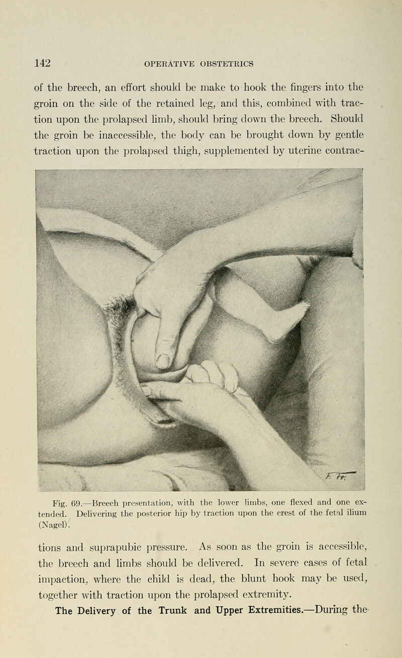 of the breech, an effort should be make to hook the fingers into the groin on the side of the retained leg, and this, combined with trac- tion upon the prolapsed limb, should bring down the breech. Should the groin be inaccessible, the body can be brought down by gentle traction upon the prolapsed thigh, supplemented by uterine contrac- ^„,4<M**s£w Fig. 69.—Breech presentation, with the lower limbs, one flexed and one ex- tended. Dehvering the posterior hip by traction upon the crest of the fetal ilium (Nagel). tions and suprapubic pressure. As soon as the groin is accessible, the breech and limbs should be delivered. In severe cases of fetal impaction, where the child is dead, the blunt hook may be used, together with traction upon the prolapsed extremity. The Delivery of the Trunk and Upper Extremities.—During the