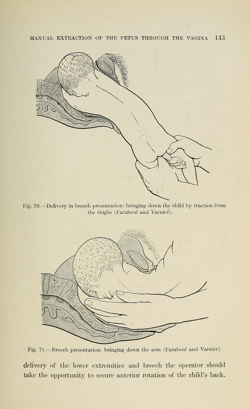 Fig. 70.—Delivery in breech presentation: bringing down the child by traction from the thighs (Farabeuf and Varnier). i€^*T- Fig. 71.—Breech presentation: bringing down the arm (Farabeuf and Varnier). delivery of the lower extremities and breech the operator should take the opportunity to secure anterior rotation of the child's back.