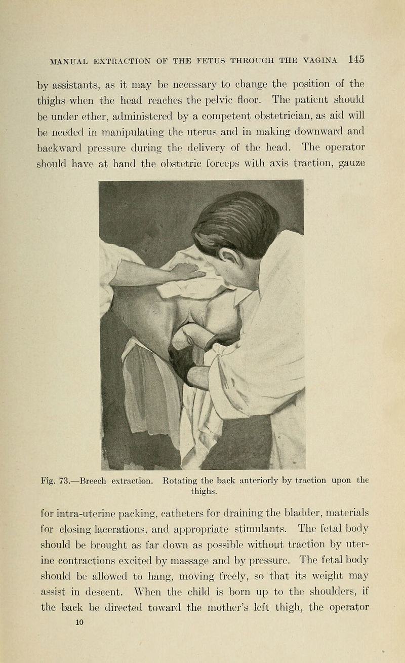 by assistants, as it may be necessary to change the position of the thighs when the head reaches the pelvic floor. The patient should be under ether, administered by a competent obstetrician, as aid will be needed in manipulating the uterus and in making downward and backward pressure during the delivery of the head. The operator should have at hand the obstetric forceps with axis traction, gauze Fig. 73.—Breech extraction. Rotating the back anteriorly by traction upon the thighs. for intra-uterine packing, catheters for draining the bladder, materials for closing lacerations, and appropriate stimulants. The fetal body should be brought as far down as possible without traction by uter- ine contractions excited by massage and by pressure. The fetal body should be allowed to hang, moving freely, so that its weight may assist in descent. When the child is born up to the shoulders, if the back be directed toward the mother's left thigh, the operator 10