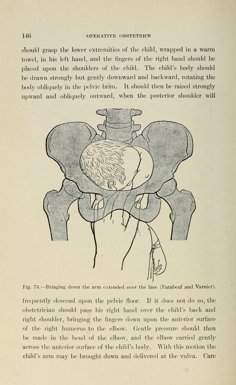 should grasp the lower extremities of the child, wrapped in a warm towel, in his left hand, and the fingers of the right hand should be placed upon the shoulders of the child. The child's body should be drawn strongly but gently downward and backward, rotating the body obliquely in the pelvic brim. It should then be raised strongly upward and obliquely outward, when the posterior shoulder will Fig. 74.—Bringing down the arm extended over the face (Farabeuf and Varnier). frequently descend upon the pelvic floor. If it does not do so, the obstetrician should pass his right hand over the child's back and right shoulder, bringing the fingers down upon the anterior surface of the right humerus to the elbow. Gentle pressure should then be made in the bend of the elbow, and the elbow carried gently across the anterior surface of the child's body. With this motion the child's arm may be brought down and delivered at the vulva. Care