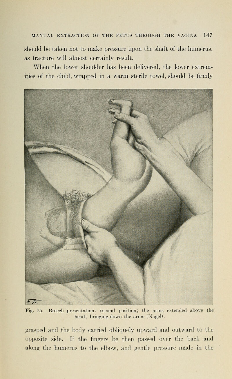 should be taken not to make pressure upon the shaft of the humerus, as fracture will almost certainly result. When the lower shoulder has been delivered, the lower extrem- ities of the child, wrapped in a warm sterile towel, should be firmly Fig. 75.—Breech presentation: second position; the arms extended above the head; bringing down the arms (Nagel). grasped and the body carried obliquely upward and outward to the opposite side. If the fingers be then passed over the back and along the humerus to the elbow, and gentle pressure made in the