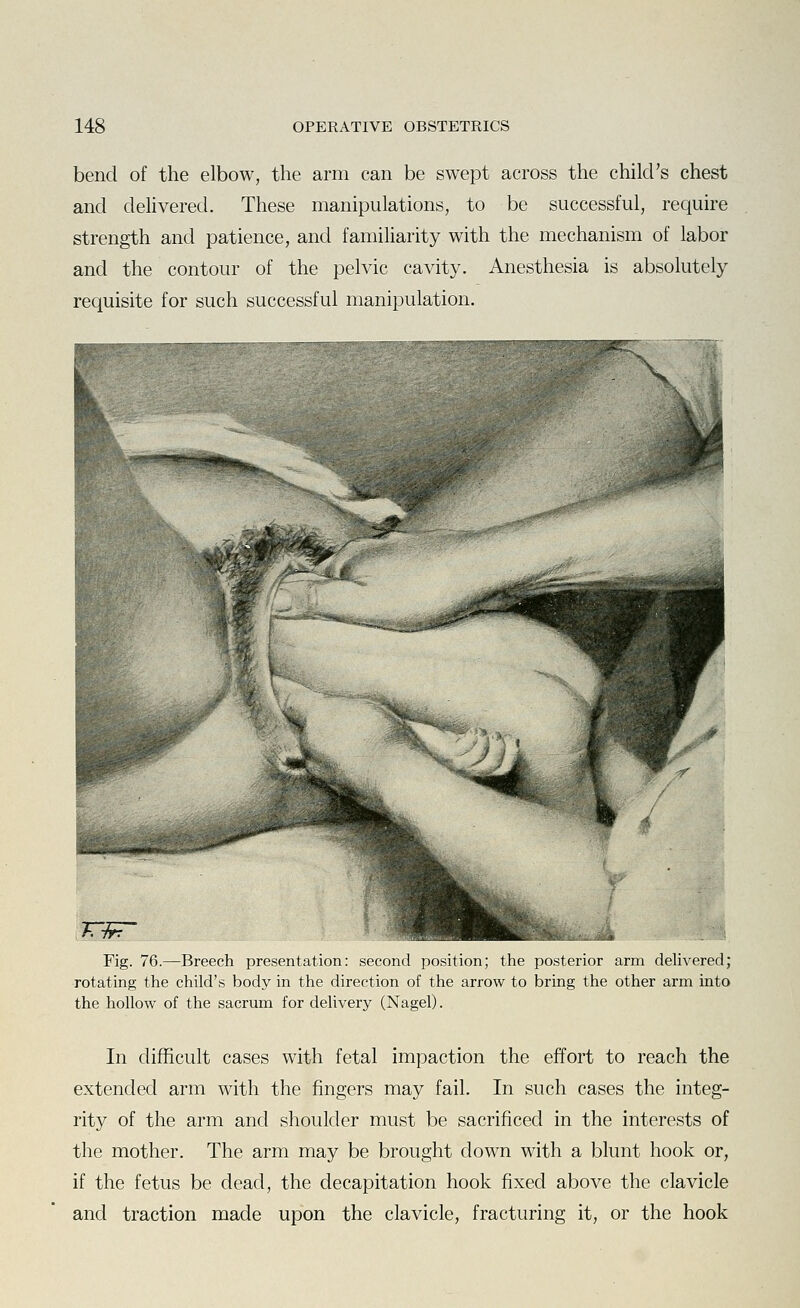 bend of the elbow, the arm can be swept across the child's chest and delivered. These manipulations, to be successful, require strength and patience, and familiarity with the mechanism of labor and the contour of the pelvic cavity. Anesthesia is absolutely requisite for such successful manipulation. TW Fig. 76.—Breech presentation: second position; the posterior arm delivered; rotating the child's body in the direction of the arrow to bring the other arm into the hollow of the sacrum for delivery (Nagel). In difficult cases with fetal impaction the effort to reach the extended arm with the fingers may fail. In such cases the integ- rity of the arm and shoulder must be sacrificed in the interests of the mother. The arm may be brought down with a blunt hook or, if the fetus be dead, the decapitation hook fixed above the clavicle and traction made upon the clavicle, fracturing it, or the hook
