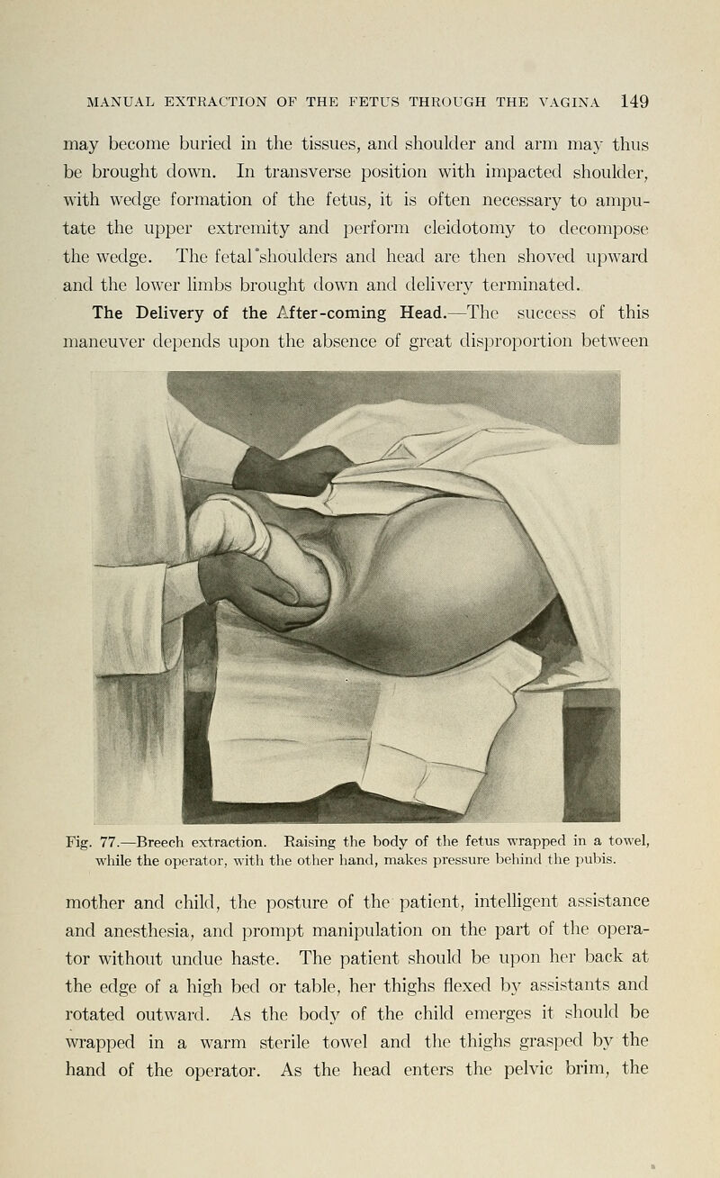 may become buried in the tissues, and shoulder and arm may thus be brought down. In transverse position with impacted shoulder, with wedge formation of the fetus, it is often necessary to ampu- tate the upper extremity and perform cleidotomy to decompose the wedge. The fetarshoulders and head are then shoved upward and the lower limbs brought down and delivery terminated. The Delivery of the After-coming Head.—The success of this maneuver depends upon the absence of great disproportion between Fig. 77.—Breech extraction. Raising the body of the fetus wrapped in a towel, while the operator, with the other hand, makes pressure behind the pubis. mother and child, the posture of the patient, intelligent assistance and anesthesia, and prompt manipulation on the part of the opera- tor without undue haste. The patient should be upon her back at the edge of a high bed or table, her thighs flexed by assistants and rotated outward. As the body of the child emerges it should be wrapped in a warm sterile towel and the thighs grasped by the hand of the operator. As the head enters the pelvic brim, the