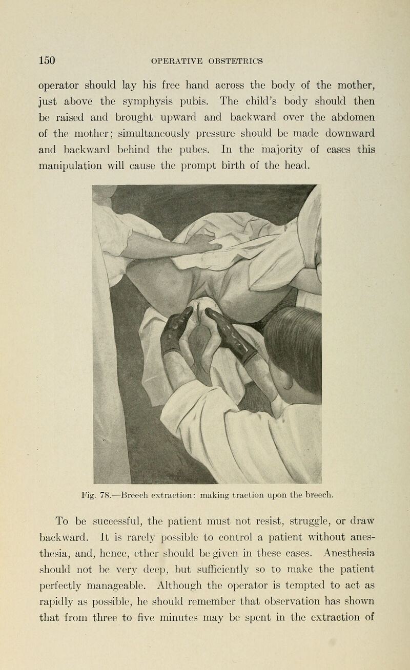 operator should lay his free hand across the body of the mother, just above the symphysis pubis. The child's body should then be raised and brought upward and backward over the abdomen of the mother; simultaneously pressure should be made downward and backward behind the pubes. In the majority of cases this manipulation will cause the prompt birth of the head. Fig. 78.—Breech extraction: making traction upon the breech. To be successful, the patient must not resist, struggle, or draw backward. It is rarely possible to control a patient without anes- thesia, and, hence, ether should be given in these cases. Anesthesia should not be very deep, but sufficiently so to make the patient perfectly manageable. Although the operator is tempted to act as rapidly as possible, he should remember that observation has shown that from three to five minutes may be spent in the extraction of