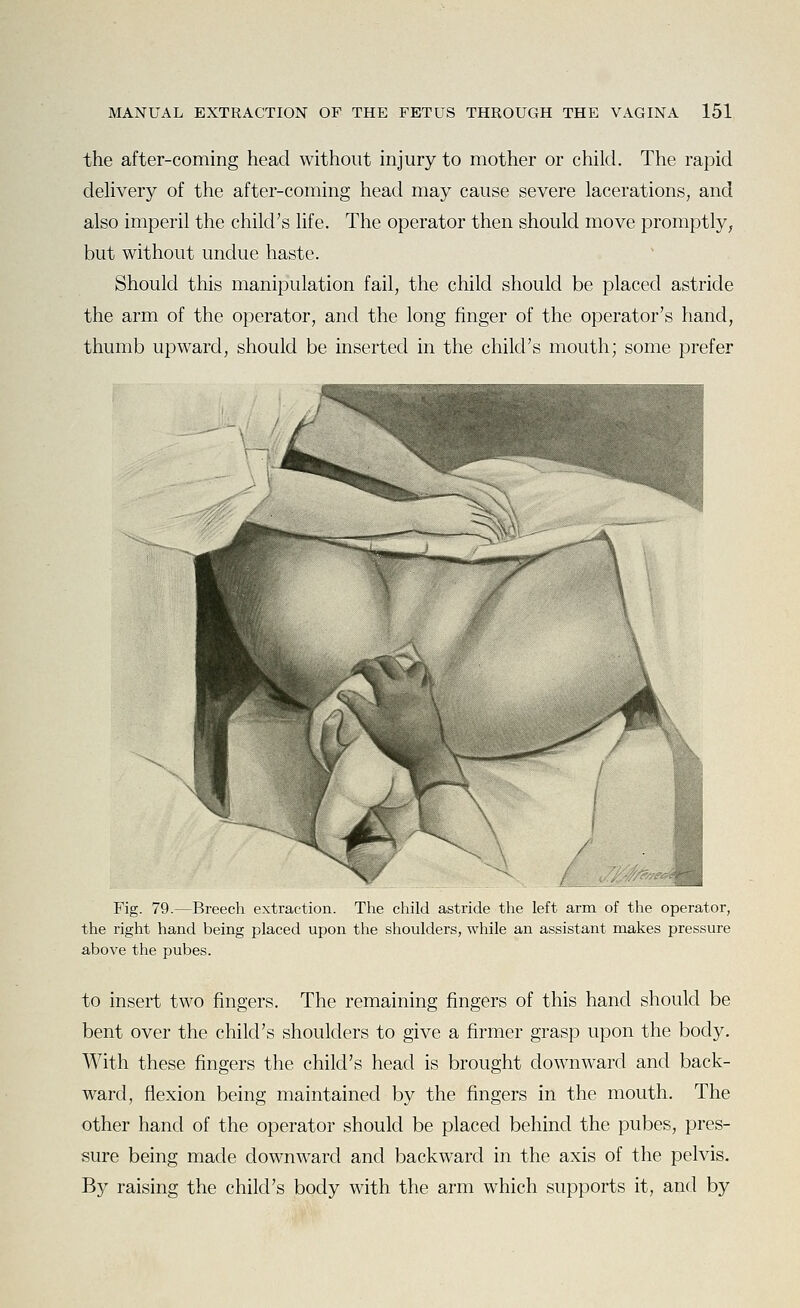 the after-coming head without injury to mother or child. The rapid delivery of the after-coming head may cause severe lacerations, and also imperil the child's life. The operator then should move promptly^ but without undue haste. Should this manipulation fail, the child should be placed astride the arm of the operator, and the long finger of the operator's hand, thumb upward, should be inserted in the child's mouth; some prefer Fig. 79.—Breech extraction. The child astride the left arm of the operator, the right hand being placed upon the shoulders, while an assistant makes pressure above the pubes. to insert two fingers. The remaining fingers of this hand should be bent over the child's shoulders to give a firmer grasp upon the body. With these fingers the child's head is brought downward and back- ward, flexion being maintained by the fingers in the mouth. The other hand of the operator should be placed behind the pubes, pres- sure being made downward and backward in the axis of the pelvis. By raising the child's body with the arm which supports it, and by