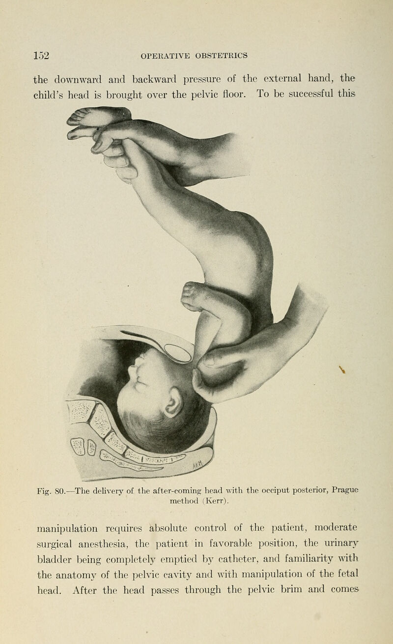 the downward and backward pressure of the external hand, the child's head is brought over the pelvic floor. To be successful this Fig. 80.—The delivery of the after-coming head with the occiput posterior, Prague method (Kerr). manipulation requires absolute control of the patient, moderate surgical anesthesia, the patient in favorable position, the urinary bladder being completely emptied by catheter, and familiarity with the anatomy of the pelvic cavity and with manipulation of the fetal head. After the head passes through the pelvic brim and come&