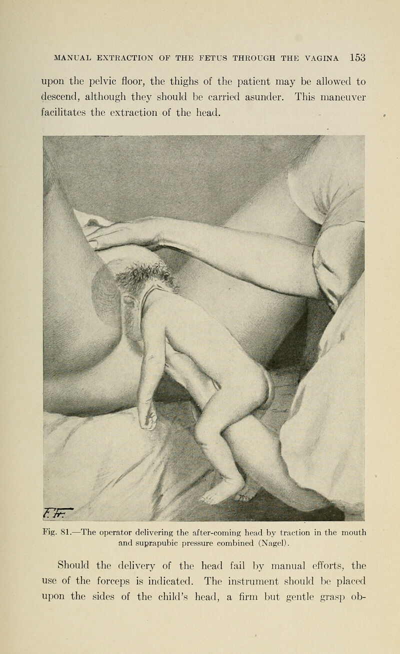 upon the pelvic floor, the thighs of the patient may be allowed to descend, although they should be carried asunder. This maneuver facilitates the extraction of the head. .I'X'W'f^^^W^^-^^f^'^^'^^S^^ Fig. 81.—The operator delivering the after-coming head by traction in the mouth and suprapubic pressure combined (Nagel). Should the delivery of the head fail by manual efforts, the use of the forceps is indicated. The instrument should be placed upon the sides of the child's head, a firm but gentle grasp ob-