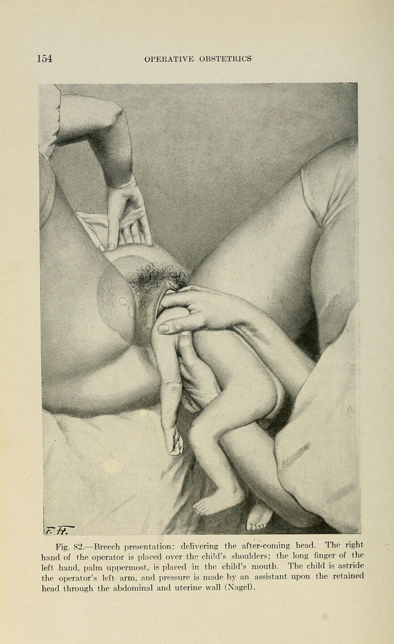 V ^ r¥7r Fig. 82.—Breech presentation: delivering the after-coming head. The right hand of the operator is placed over the child's shoulders; the long finger of the left hand, palm uppermost, is placed in the child's mouth. The child is astride the operator's left arm, and pressure is made by an assistant upon the retained head through the abdominal and uterine wall (Nagel).
