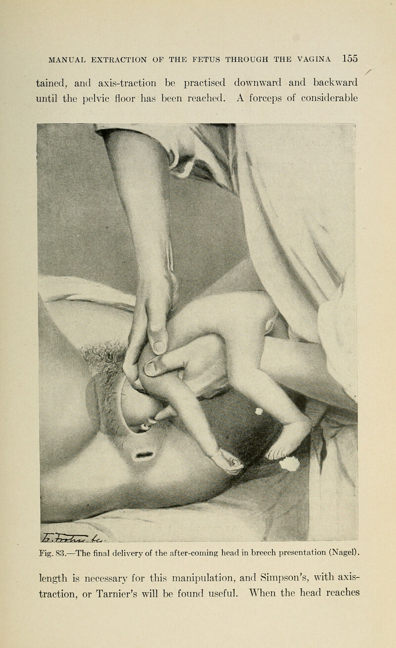 tained, and axis-traction be practised downward and backward until the pelvic floor has been reached. A forceps of considerable Fig. 83.—The final delivery of the after-coming head in breech presentation (Nagel). length is necessary for this manipulation, and Simpson's, with axis- traction, or Tarnier's will be found useful. When the head reaches