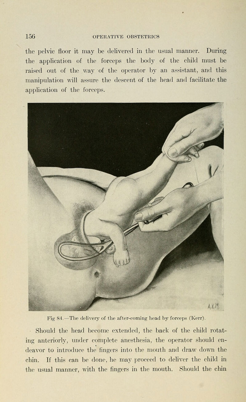 the pelvic floor it may be delivered in the usual manner. During the application of the forceps the body of the child must be raised out of the way of the operator by an assistant, and this manipulation will assure the descent of the head and facilitate the application of the forceps. Fig 84.—The delivery of the after-coming head by forceps (Kerr), • Should the head become extended, the back of the child rotat- ing anteriorly, under complete anesthesia, the operator should en- deavor to introduce the fingers into the mouth and draw down the chin. If this can be done, he may proceed to deliver the child in the usual manner, with the fingers in the mouth. Should the chin