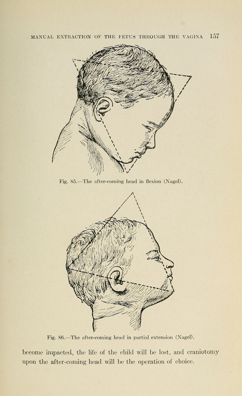 Fig. 85.—The after-coming head in flexion (Nagel). Fig. 86.—The after-coming head in partial extension (Nagel). become impacted, the life of the child will be lost, and craniotomy upon the after-coming head will be the operation of choice.