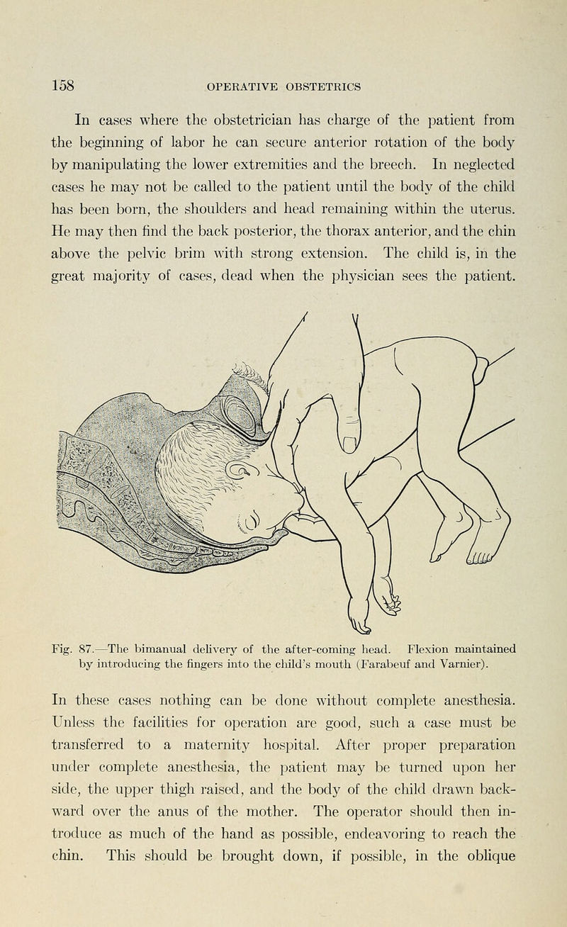 In cases where the obstetrician has charge of the patient from the beginning of labor he can secure anterior rotation of the body by manipulating the lower extremities and the breech. In neglected cases he may not be called to the patient until the body of the child has been born, the shoulders and head remaining within the uterus. He may then find the back posterior, the thorax anterior, and the chin above the pelvic brim with strong extension. The child is, in the great majority of cases, dead when the physician sees the patient. Fig. 87.—The bimanual delivery of the after-coming head. Flexion maintained by introducing the fingers into the child's mouth (Farabeuf and Varnier). In these cases nothing can be done without complete anesthesia. Unless the facilities for operation are good, such a case must be transferred to a maternity hospital. After proper preparation under complete anesthesia, the patient may be turned upon her side, the upper thigh raised, and the body of the child drawn back- ward over the anus of the mother. The operator should then in- troduce as much of the hand as possible, endeavoring to reach the chin. This should be brought down, if possible, in the oblique