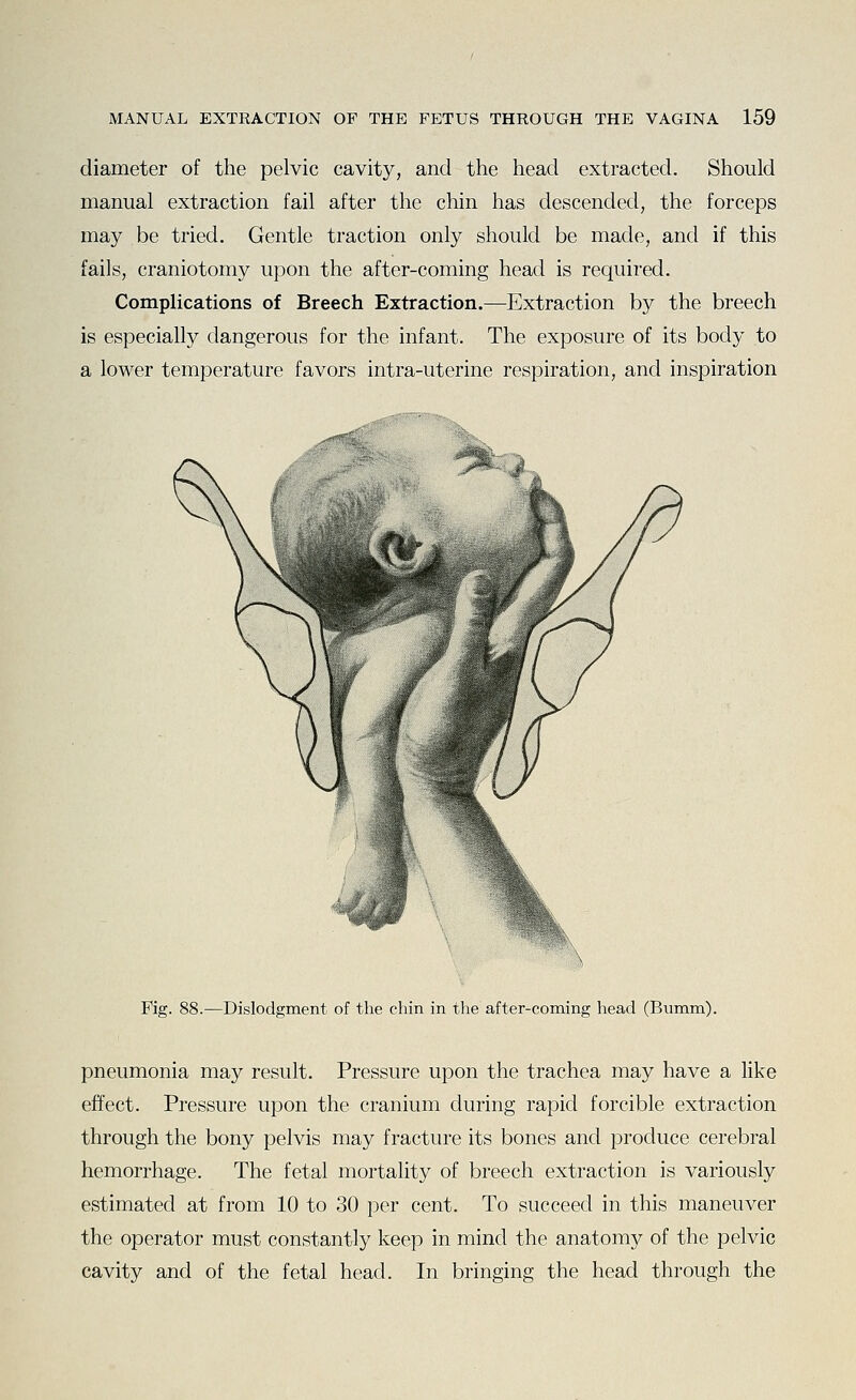 diameter of the pelvic cavity, and the head extracted. Should manual extraction fail after the chin has descended, the forceps may be tried. Gentle traction only should be made, and if this fails, craniotomy upon the after-coming head is required. Complications of Breech Extraction.—Extraction by the breech is especially dangerous for the infant. The exposure of its body to a lower temperature favors intra-uterine respiration, and inspiration Fig. 88.—Dislodgment of the chin in the after-coming head (Bumm). pneumonia may result. Pressure upon the trachea may have a like effect. Pressure upon the cranium during rapid forcible extraction through the bony pelvis may fracture its bones and produce cerebral hemorrhage. The fetal mortality of breech extraction is variously estimated at from 10 to 30 per cent. To succeed in this maneuver the operator must constantly keep in mind the anatomy of the pelvic cavity and of the fetal head. In bringing the head through the