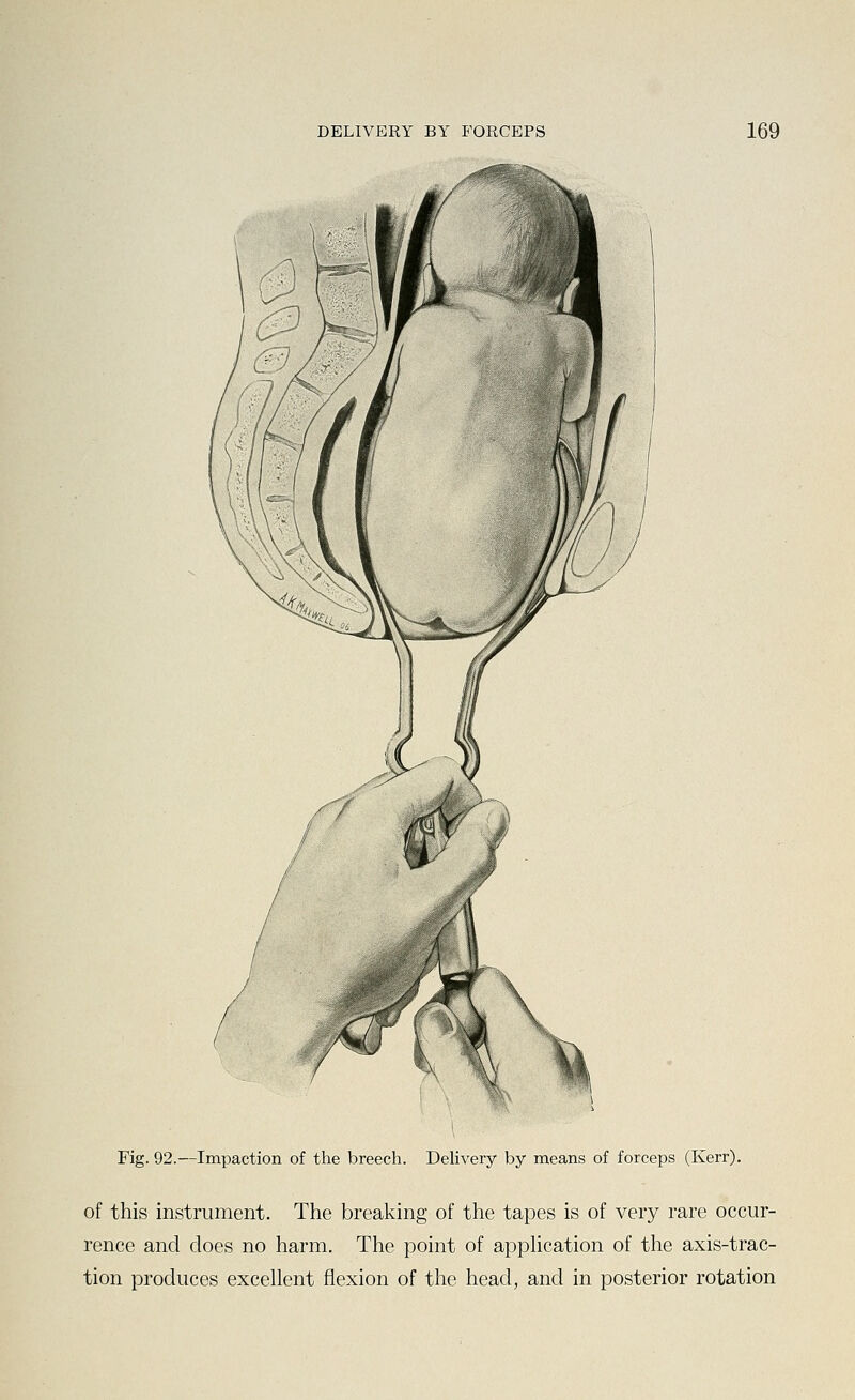 Fig. 92.—Impaction of the breech. Delivery by means of forceps (Kerr). of this instrument. The breaking of the tapes is of very rare occur- rence and does no harm. The point of apphcation of the axis-trac- tion produces excellent flexion of the head, and in posterior rotation