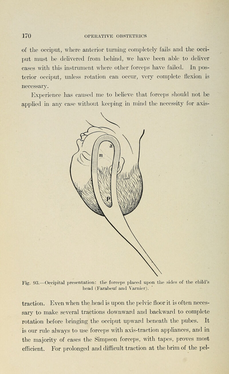 of the occiput, where anterior turning completely fails and the occi- put must be delivered from behind, we have been able to deliver cases with this instrument where other forceps have failed. In pos- terior occiput, unless rotation can occur, very complete flexion is necessary. Experience has caused me to believe that forceps should not be applied in any case without keeping in mind the necessity for axis- Fig. 93.—Occipital presentation: tHe forceps placed upon the sides of the child's head (Farabeuf and Varnier). traction. Even when the head is upon the pelvic floor it is often neces- sary to make several tractions downward and backward to complete rotation before bringing the occiput upward beneath the pubes. It is our rule always to use forceps with axis-traction appliances, and in the majority of cases the Simpson forceps, with tapes, proves most efficient. For prolonged and difficult traction at the brim of the pel-