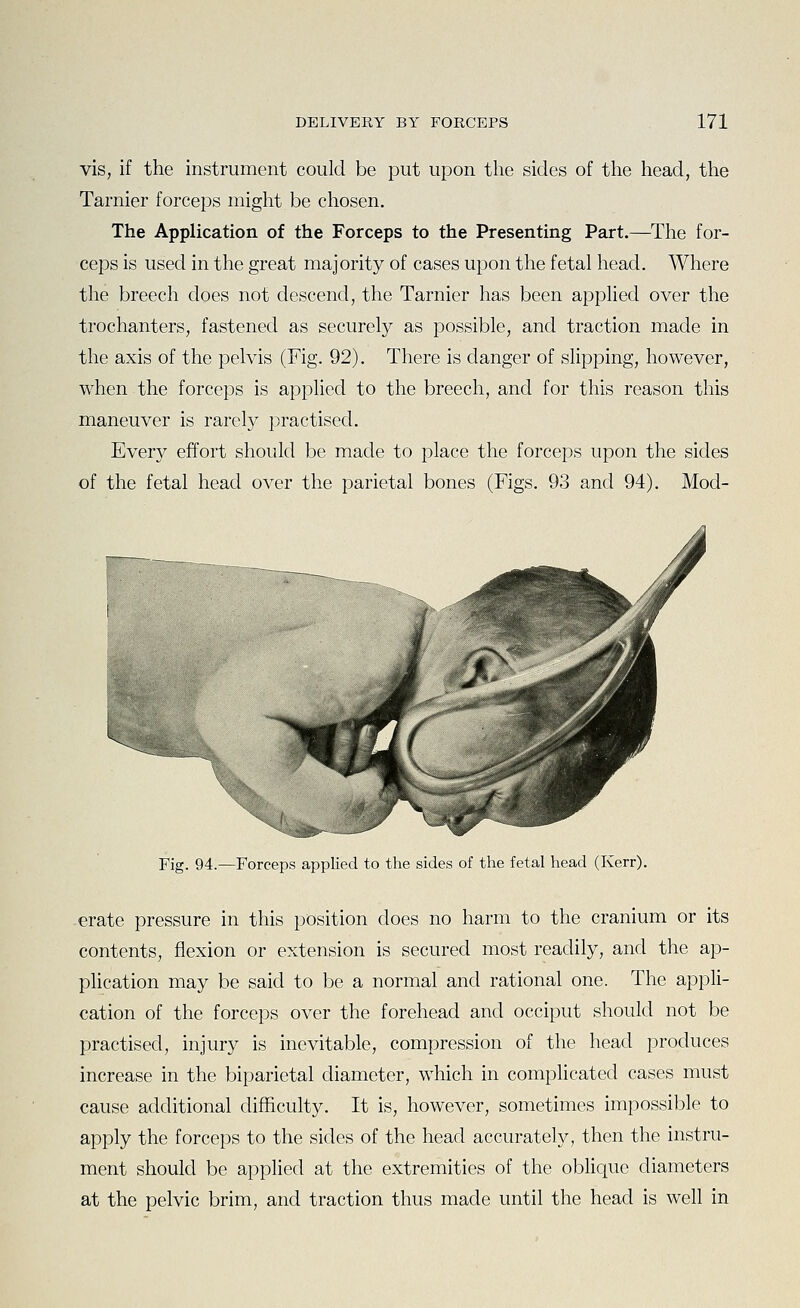 vis, if the instrument could be put upon the sides of the head, the Tarnier forceps might be chosen. The Application of the Forceps to the Presenting Part.—The for- ceps is used in the great majority of cases upon the fetal head. Where the breech does not descend, the Tarnier has been applied over the trochanters, fastened as securely as possible, and traction made in the axis of the pelvis (Fig. 92). There is danger of slipping, however, when the forceps is applied to the breech, and for this reason this maneuver is rarely practised. Every effort should be made to place the forceps upon the sides of the fetal head over the parietal bones (Figs. 93 and 94). Mod- ^!fiv|:^T^ Fig. 94.—Forceps applied to the sides of the fetal head (Kerr). -erate pressure in this position does no harm to the cranium or its contents, flexion or extension is secured most readily, and the ap- plication may be said to be a normal and rational one. The appli- cation of the forceps over the forehead and occiput should not be practised, injury is inevitable, compression of the head produces increase in the biparietal diameter, which in comphcated cases must cause additional difficulty. It is, however, sometimes impossible to apply the forceps to the sides of the head accurately, then the instru- ment should be applied at the extremities of the obHque diameters at the pelvic brim, and traction thus made until the head is well in