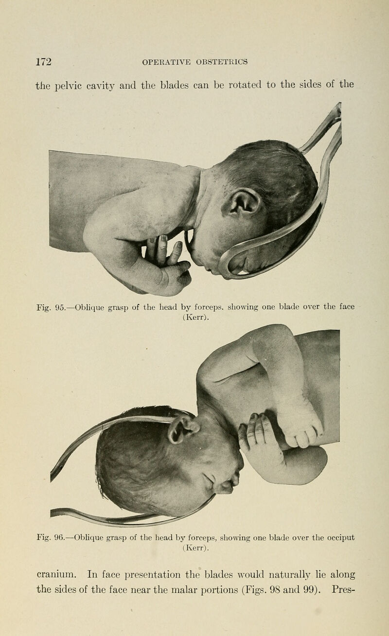 the pelvic cavit)^ and the blades can be rotated to the sides of the Fig. 95.—Oblique grasp of the head by forceps, showing one blade over the face (Kerr). Fig. 96.—Oblique grasp of the head by forceps, showing one blade over the occiput (Kerr). cranium. In face presentation the blades would naturally lie along the sides of the face near the malar portions (Figs. 98 and 99). Pres-