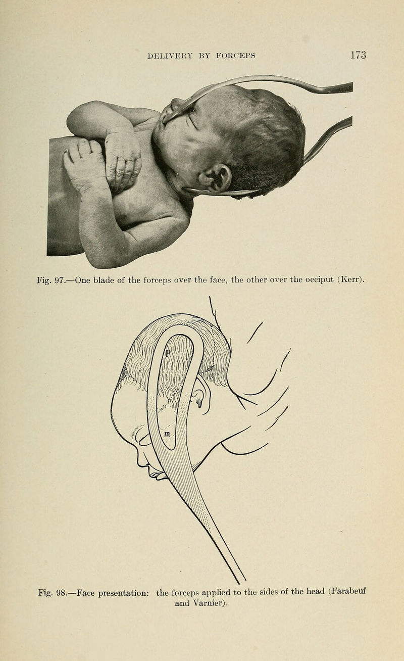 Fig. 97.—One blade of the forceps over the face, the other over the occiput (Kerr). Fig. 98.—Face presentation: the forceps applied to the sides of the head (Farabeuf and Varnier).