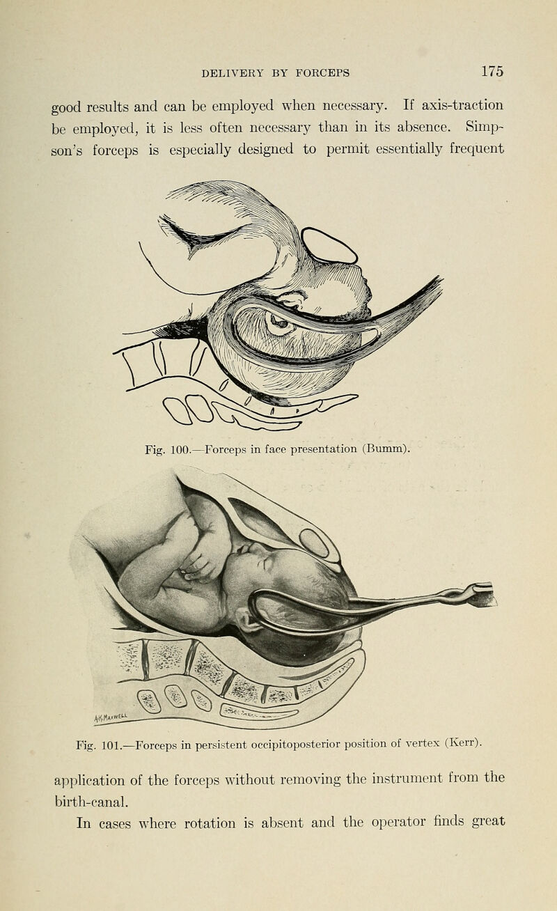 good results and can be employed when necessary. If axis-traction be employed, it is less often necessary than in its absence. Simp- son's forceps is especially designed to permit essentially frequent Fig. 100.—Forceps in face presentation (Bumm). Fig. 101.—Forceps in persistent occipitoposterior position of vertex (Kerr). application of the forceps without removing the instrument from the birth-canal. In cases where rotation is absent and the operator finds great