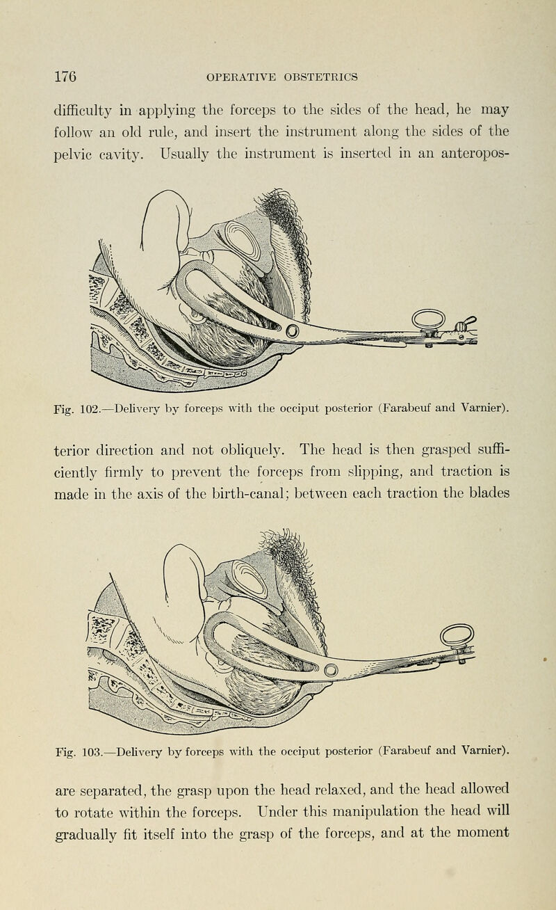 difficulty in applying the forceps to the sides of the head, he may follow an old rule, and insert the instrument along the sides of the pelvic cavity. Usually the instrument is inserted in an anteropos- Fig. 102.—Delivery by forceps with the occiput posterior (Farabeuf and Varnier). terior direction and not obliquely. The head is then grasped suffi- ciently firmly to prevent the forceps from slipping, and traction is made in the axis of the birth-canal; between each traction the blades Fig. 103.—Delivery by forceps with the occiput posterior (Farabeuf and Varnier). are separated, the grasp upon the head relaxed, and the head allowed to rotate within the forceps. Under this manipulation the head will gradually fit itself into the grasp of the forceps, and at the moment