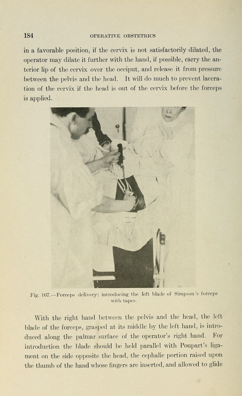 in a favorable position, if the cervix is not satisfactorily dilated, the operator may dilate it further with the hand, if possible, carry the an- terior lip of the cervix over the occiput, and release it from pressure between the pelvis and the head. It will do much to prevent lacera- tion of the cervix if the head is out of the cervix before the forceps is applied. w Pig. 107.—Forceps delivery: introducing the left blade of Simpson's forceps with tapes. With the right hand between the pelvis and the head, the left blade of the forceps, grasped at its middle by the left hand, is intro- duced along the palmar surface of the operator's right hand. For introduction the blade should be held parallel with Poupart's liga- ment on the side opposite the head, the cephalic portion raised upon the thumb of the hand whose fingers are inserted, and allowed to glide