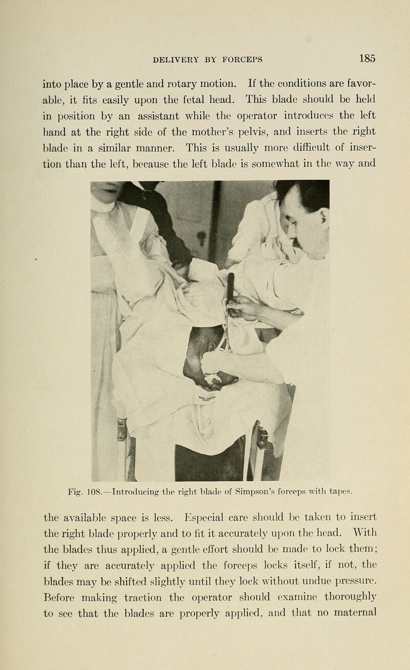 into place by a gentle and rotary motion. If the conditions are favor- able, it fits easily upon the fetal head. This blade should be held in position by an assistant while the operator introduces the left hand at the right side of the mother's pelvis, and inserts the right blade in a similar manner. This is usually more difficult of inser- tion than the left, because the left blade is somewhat in the way and Fig. 108.—Introducing the right blade of Simpson's forceps with tapes. the available space is less. Especial care should be taken to insert the right blade properly and to fit it accurately upon the head. With the blades thus applied, a gentle effort should be made to lock them; if they are accurately applied the forceps locks itself, if not, the blades may be shifted slightly until they lock without undue pressure. Before making traction the operator should examine thoroughly to see that the blades are properly apphed, and that no maternal