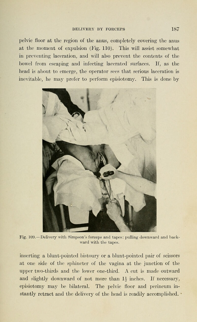 pelvic floor at the region of the anus, completely covering the anus at the moment of expulsion (Fig. 110). This will assist somewhat in preventing laceration, and will also prevent the contents of the bowel from escaping and infecting lacerated surfaces. If, as the head is about to emerge, the operator sees that serious laceration is inevitable, he may prefer to perform episiotomy. This is done by Fig. 1U9.—Delivery with Simpson's forceps and tapes: pulling downward and back- ward with the tapes. inserting a blunt-pointed bistoury or a blunt-pointed pair of scissors at one side of the sphincter of the vagina at the junction of the upper two-thirds and the lower one-third. A cut is made outward and slightly downward of not more than IJ inches. If necessary, episiotomy may be bilateral. The pelvic floor and perineum in- stantly retract and the delivery of the head is readily accomplished. '