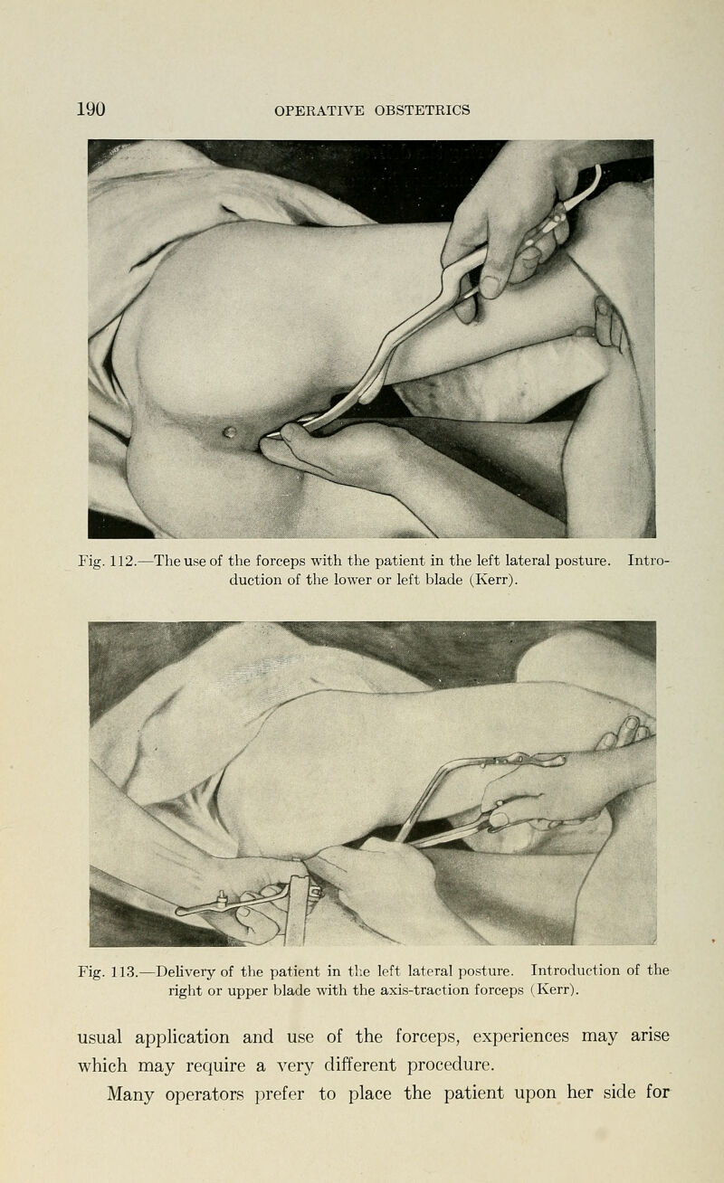 Fig. 112.—The use of the forceps with the patient in the left lateral posture. Intro- duction of the lower or left blade (Kerr). Fig. 113.—Delivery of the patient in the left lateral posture. Introduction of the right or upper blade with the axis-traction forceps (Kerr). usual application and use of the forceps, experiences may arise which may require a very different procedure. Many operators prefer to place the patient upon her side for