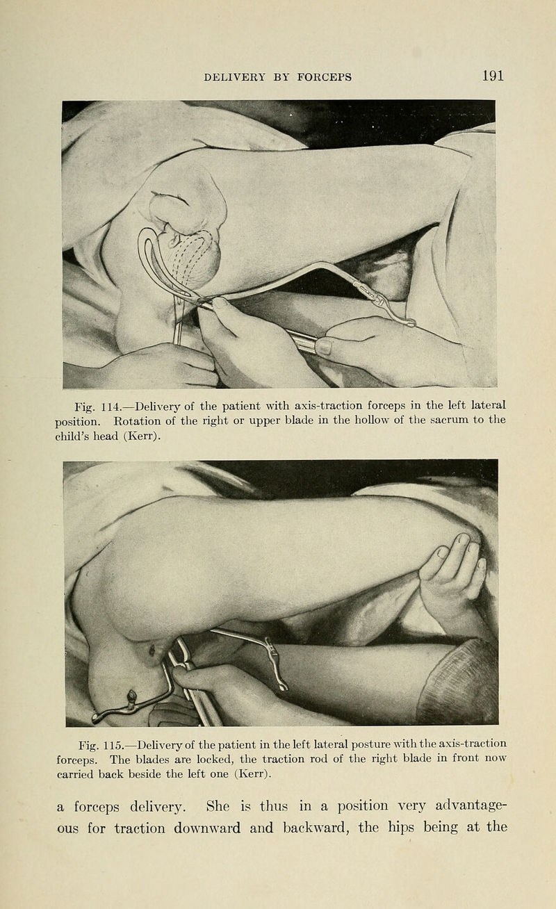 Fig. 114.—Delivery of the patient with axis-traction forceps in the left lateral position. Rotation of the right or upper blade in the hollow of the sacrum to the child's head (Kerr). Fig. 115.—DeUvery of the patient in the left lateral posture with the axis-traction forceps. The blades are locked, the traction rod of the right blade in front now carried back beside the left one (Kerr). a forceps delivery. She is thus in a position very advantage- ous for traction downward and backward, the hips being at the