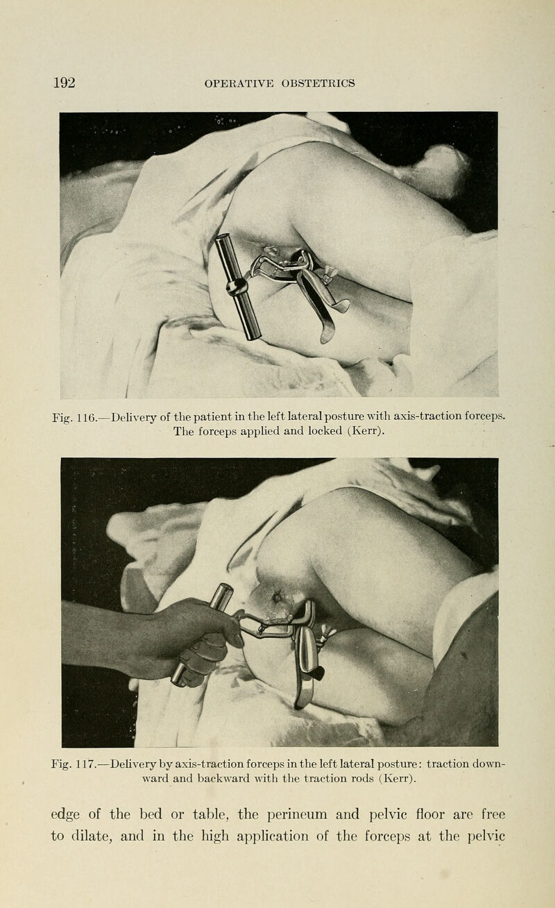 Fig. 116.—Delivery of the patient in the left lateral posture with axis-traction forceps. The forceps applied and locked (Kerr). Fig. 117.—DeUvery by axis-traction forceps in the left lateral posture: traction down- ward and backward with the traction rods (Kerr). edge of the bed or table, the perineum and pelvic floor are free to dilate, and in the high application of the forceps at the pelvic
