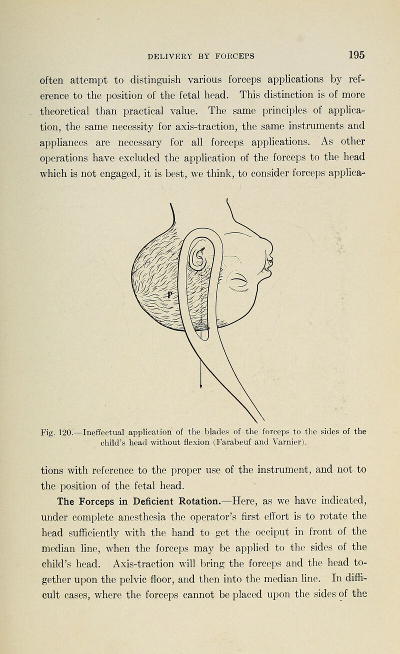 often attempt to distinguish various forceps applications by ref- erence to the position of the fetal head. This distinction is of more theoretical than practical value. The same principles of applica- tion, the same necessity for axis-traction, the same instruments and appliances are necessary for all forceps applications. As other operations have excluded the application of the forceps to the head which is not engaged, it is best, we think, to consider forceps applica- Fig. 120.—Ineffectual application of the blades of the forceps to the sides of the child's head without flexion (Farabeuf and Varnier). tions with reference to the proper use of the instrument, and not to the position of the fetal head. The Forceps in Deficient Rotation.—Here, as we have indicated, under complete anesthesia the operator's first effort is to rotate the head sufficiently with the hand to get the occiput in front of the median line, when the forceps may be applied to the sides of the child's head. Axis-traction will bring the forceps and the head to- gether upon the pelvic floor, and then into the median line. In diffi- cult cases, where the forceps cannot be placed upon the sides of the