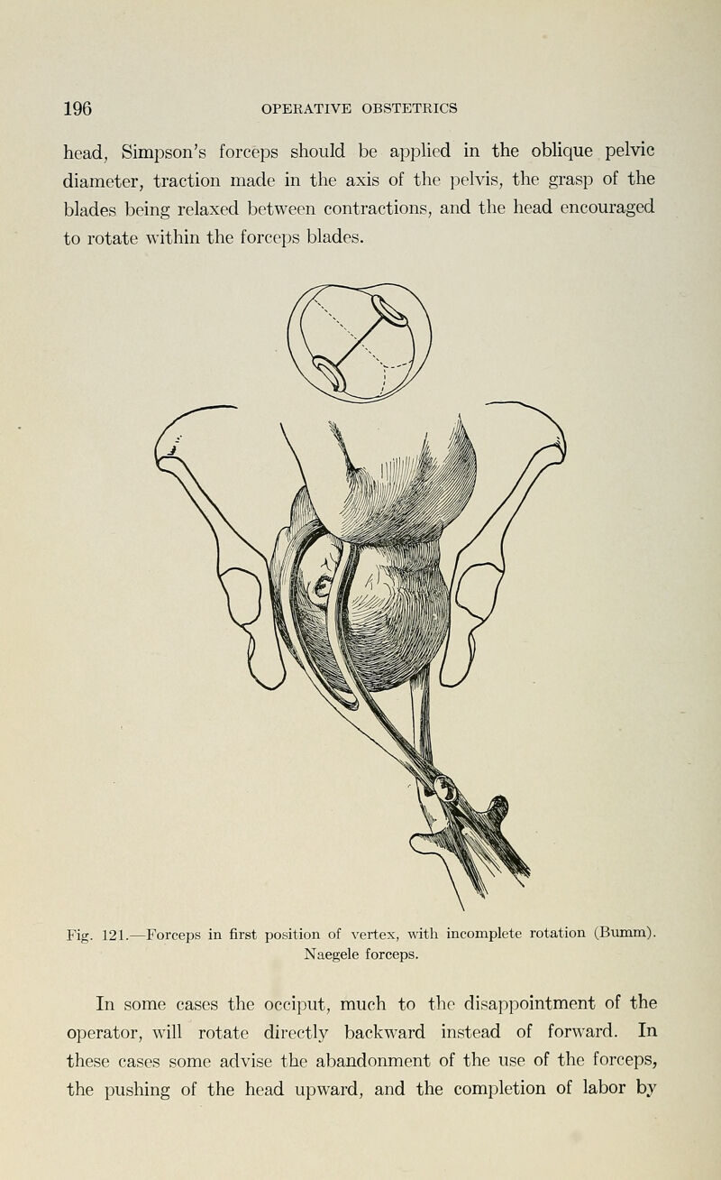 head, Simpson's forceps should be applied in the oblique pelvic diameter, traction made in the axis of the pelvis, the grasp of the blades being relaxed between contractions, and the head encouraged to rotate within the forceps blades. Fig. 121.—Forceps in first position of vertex, with incomplete rotation (Bumm). Naegele forceps. In some cases the occiput, much to the disappointment of the operator, will rotate directly backward instead of forward. In these cases some advise the abandonment of the use of the forceps, the pushing of the head upward, and the completion of labor by
